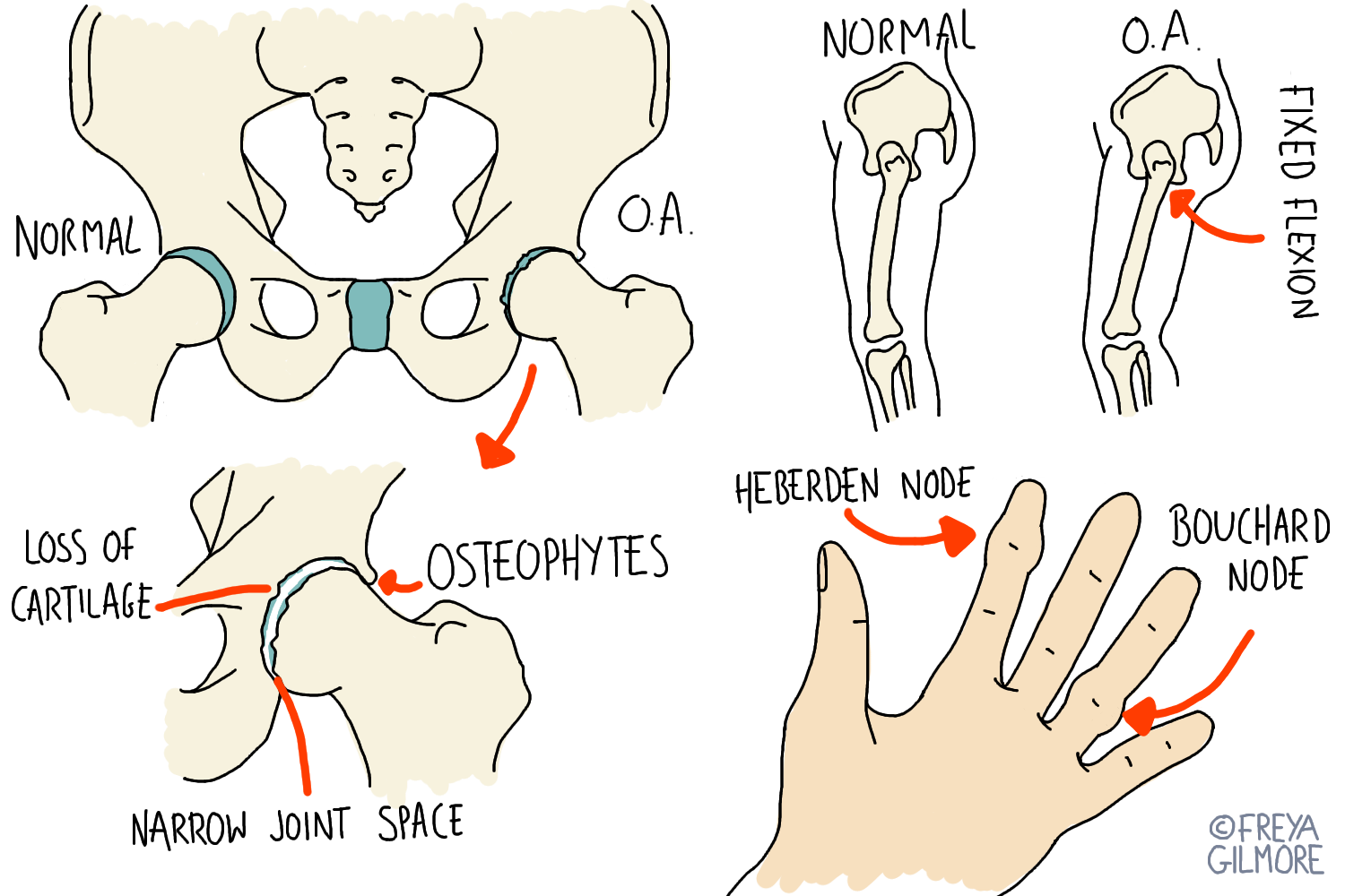 Signs of Osteoarthritis